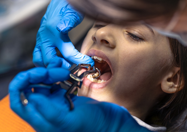 Tooth Extraction